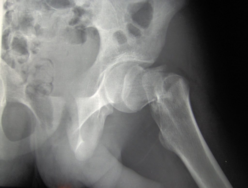 Radiografia d'un meluc, amb la part superior del fèmur fracturada / Booyabazooka