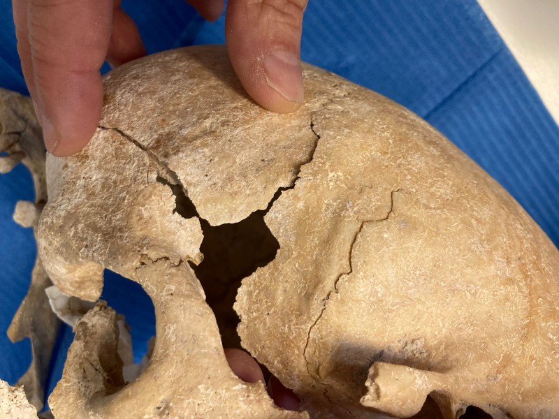 Imatge d'una de les lesions trobades al crani.